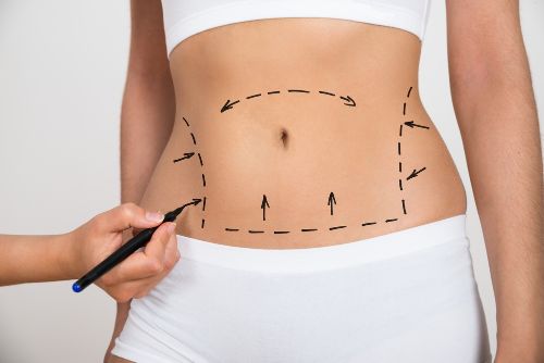stomach liposuction